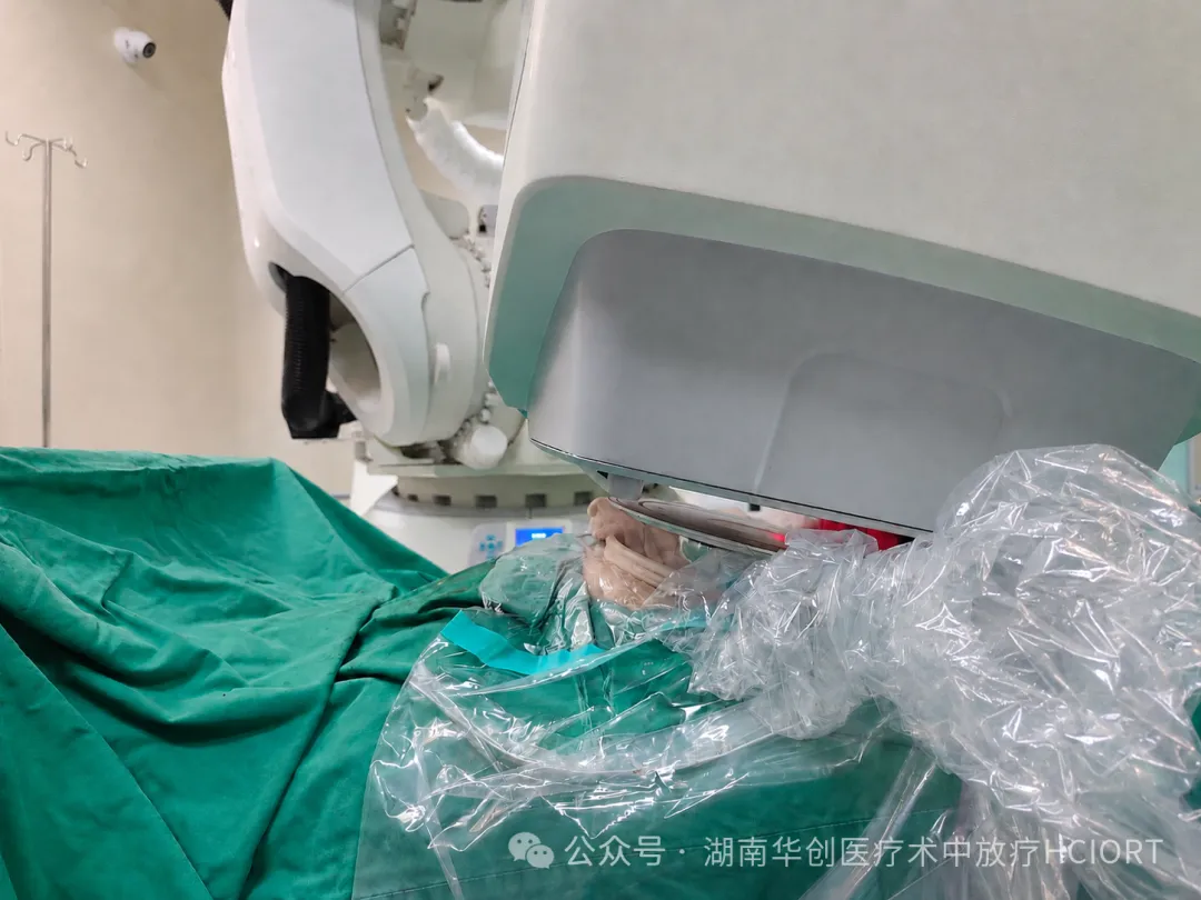 World’s First Retroperitoneal Liposarcoma IORT with an Electron Beam Spherical Applicator Completed