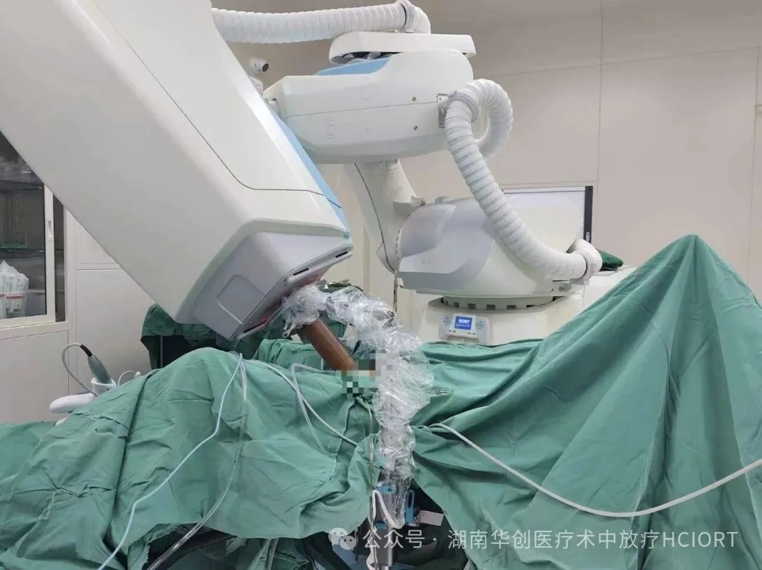 World’s First Vulvar Cancer IORT with a Mobile Electron Beam Cylindrical Applicator Completed
