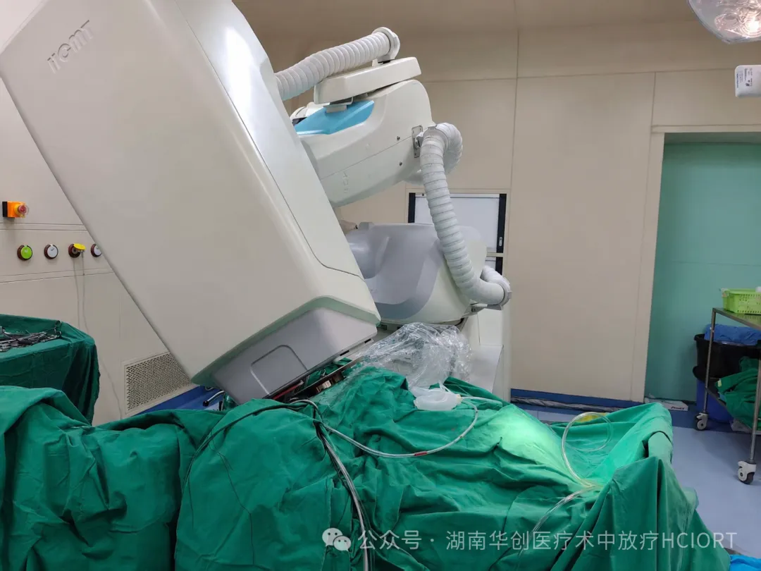 World’s First Vulvar Cancer IORT with an Electron Beam Spherical Applicator Completed