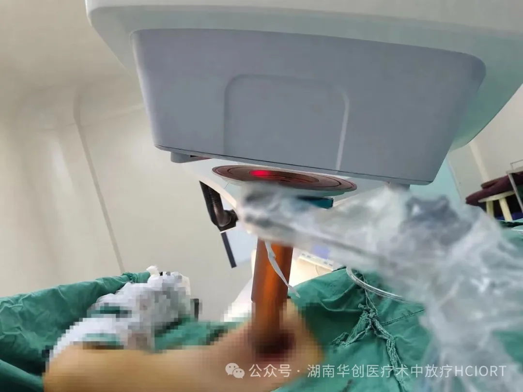 Hunan’s First Electron Beam IORT for Axillary Liposarcoma Completed