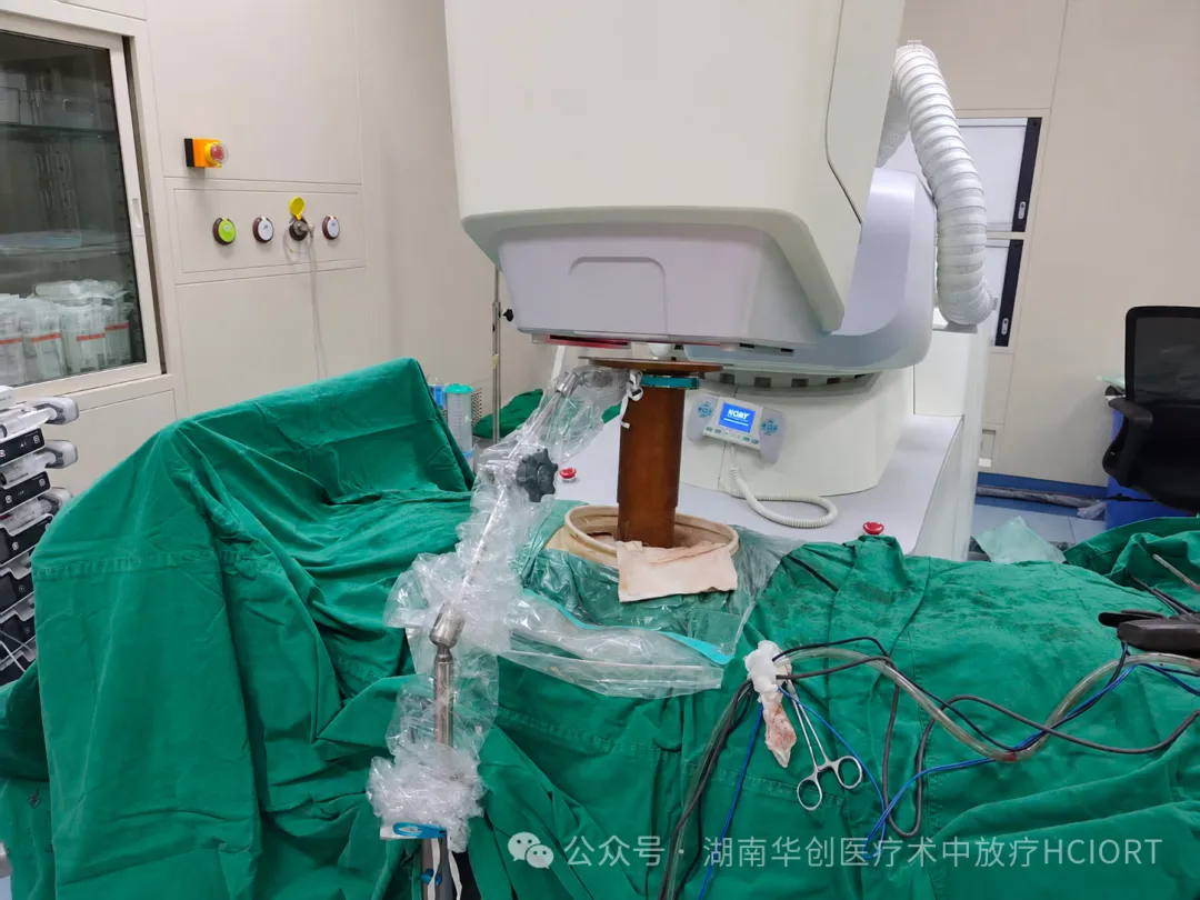 Hunan’s First Two-Lesion, Two-Field IORT Completed During a Single Retroperitoneal Tumor Operation