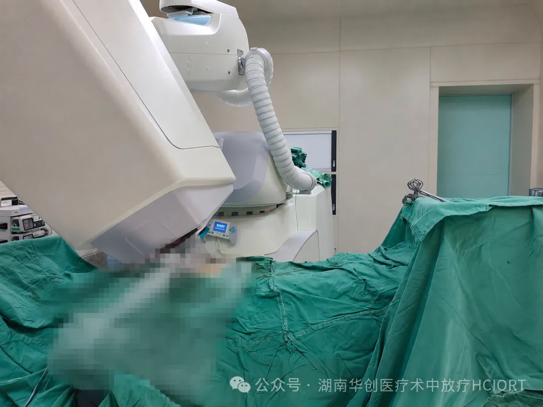 Hunan’s First IORT Procedure for Recurrent Ovarian Cancer Completed