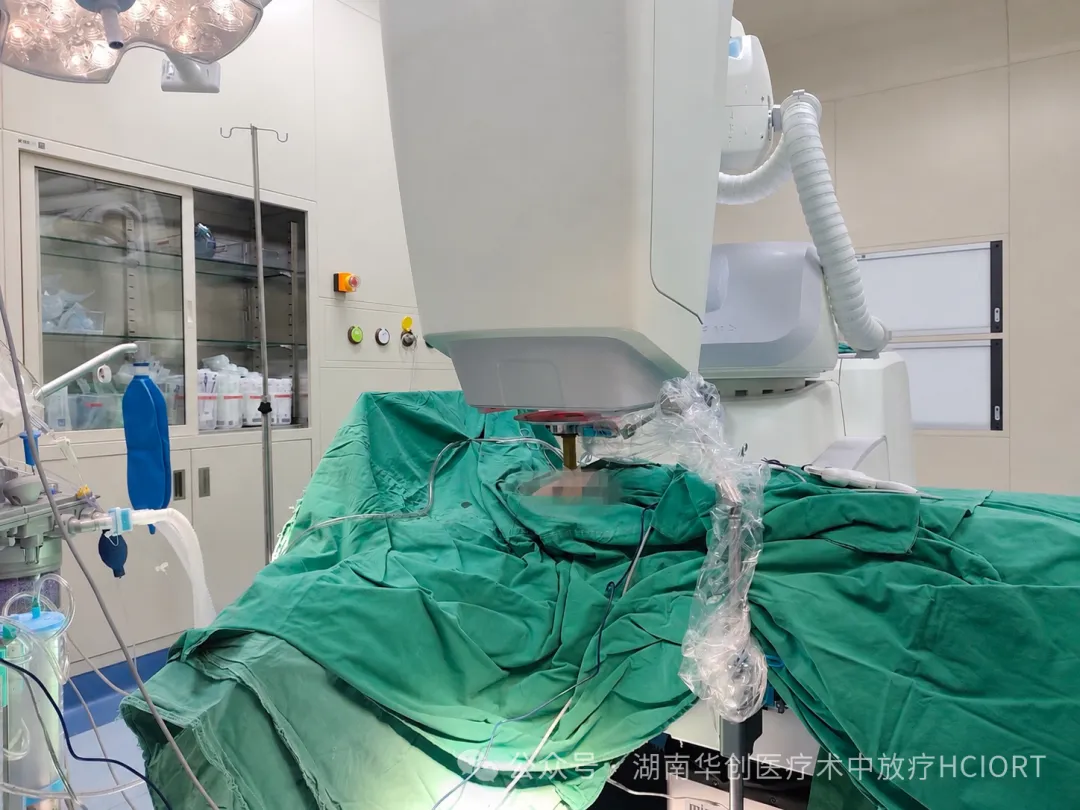 Two Breast Cancer IORT Cases Completed with a High-Dose-Rate Electron Beam Spherical Applicator